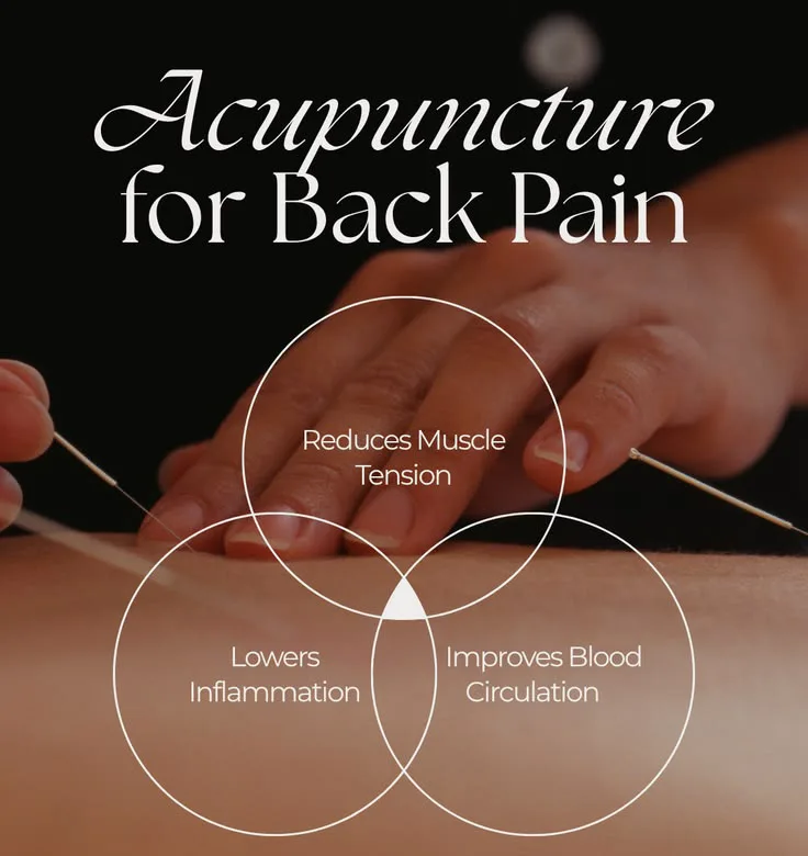 Acupuncture for Back Pain