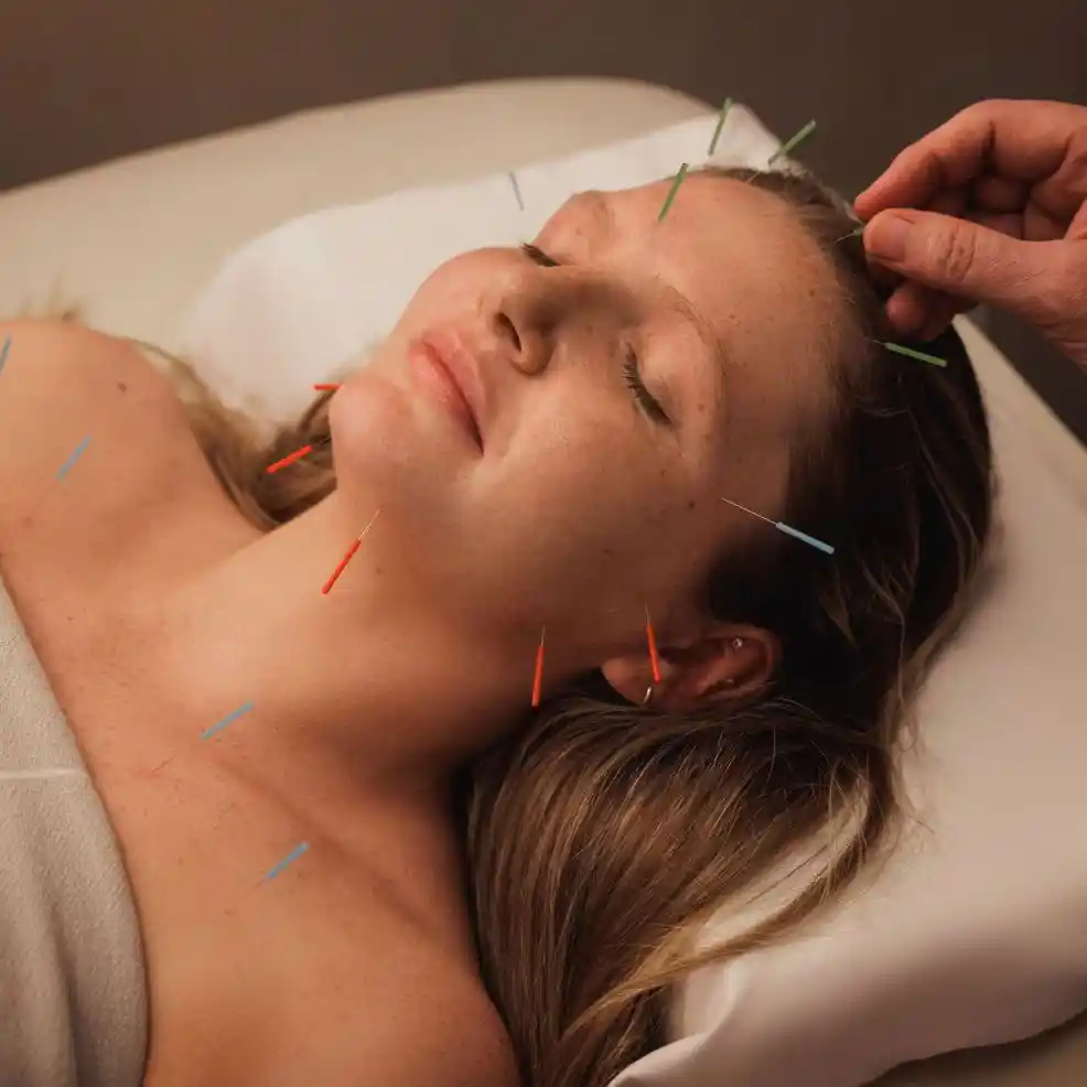 Acupuncture for Migraines